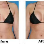 The complete guide to Breast Augmentation in Singapore – from Cost to How to Finding the best doctor