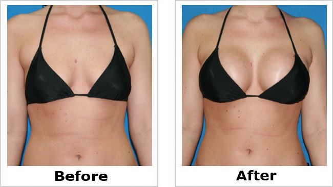 guide to Breast Augmentation